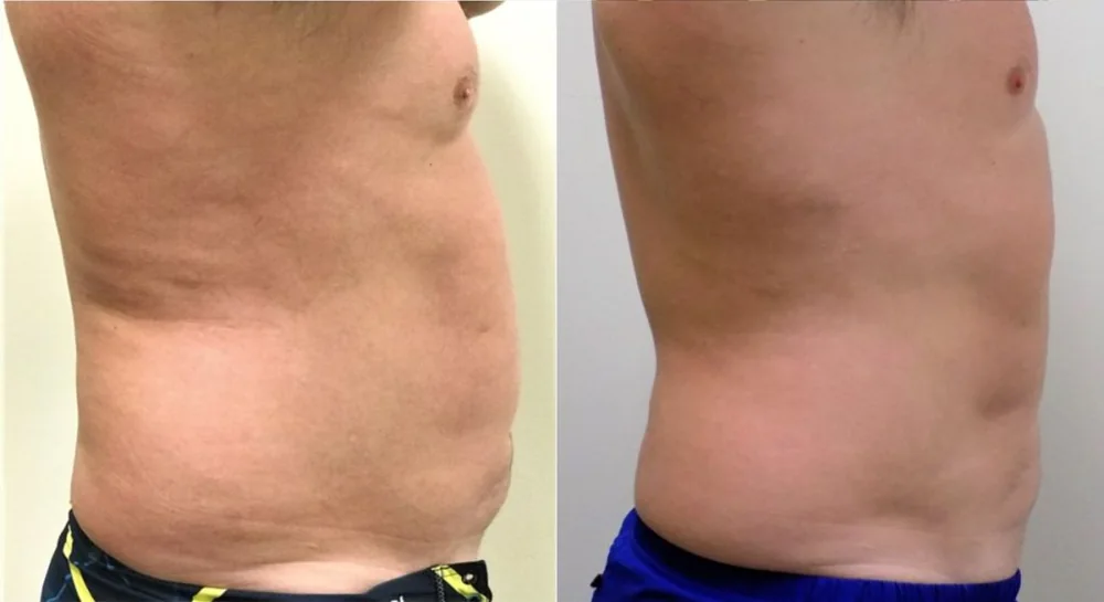 Body contouring before and after