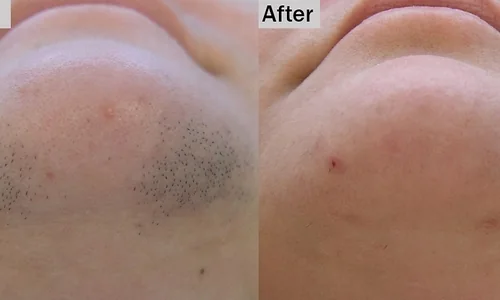 Laser hair removal before and after