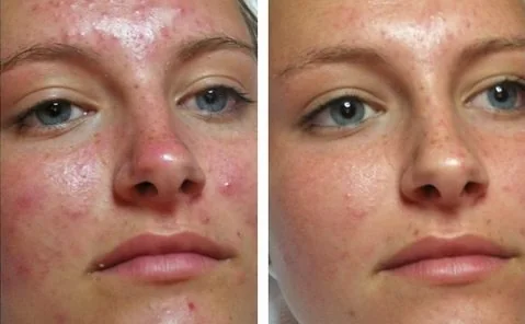 Skin treatment before and after
